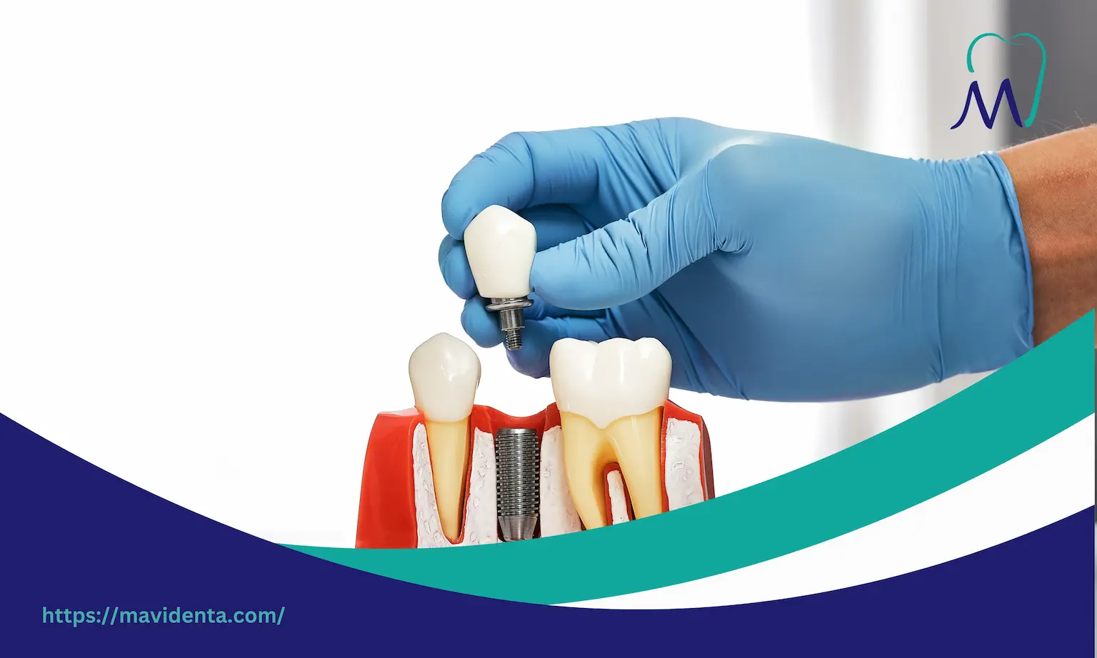 Pros and cons of all on four dental implants Плюсы и минусы всех четырёх зубных имплантатов