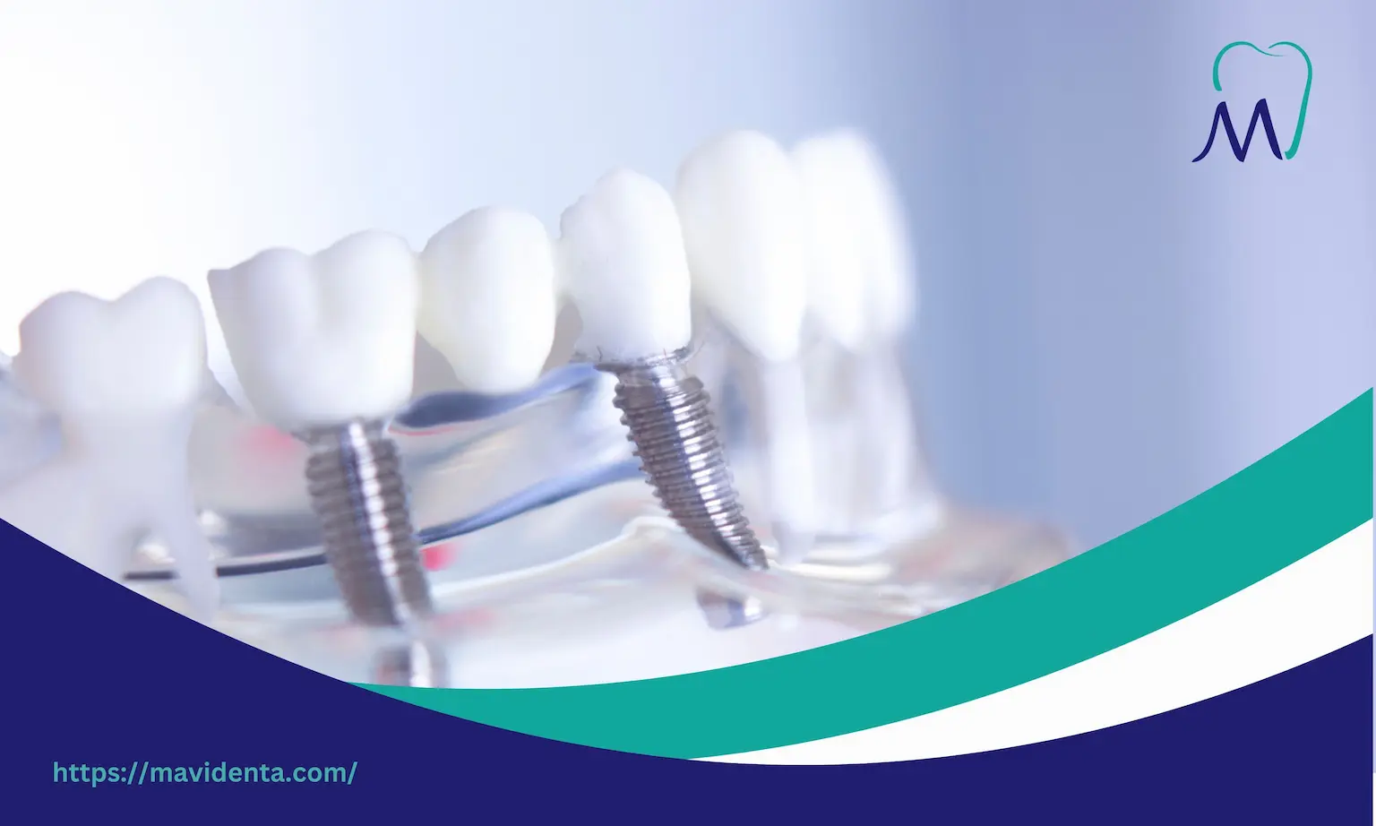 Teeth Done in Turkey Prices  Teeth Done in Turkey Prices Overview for Best Dental Care