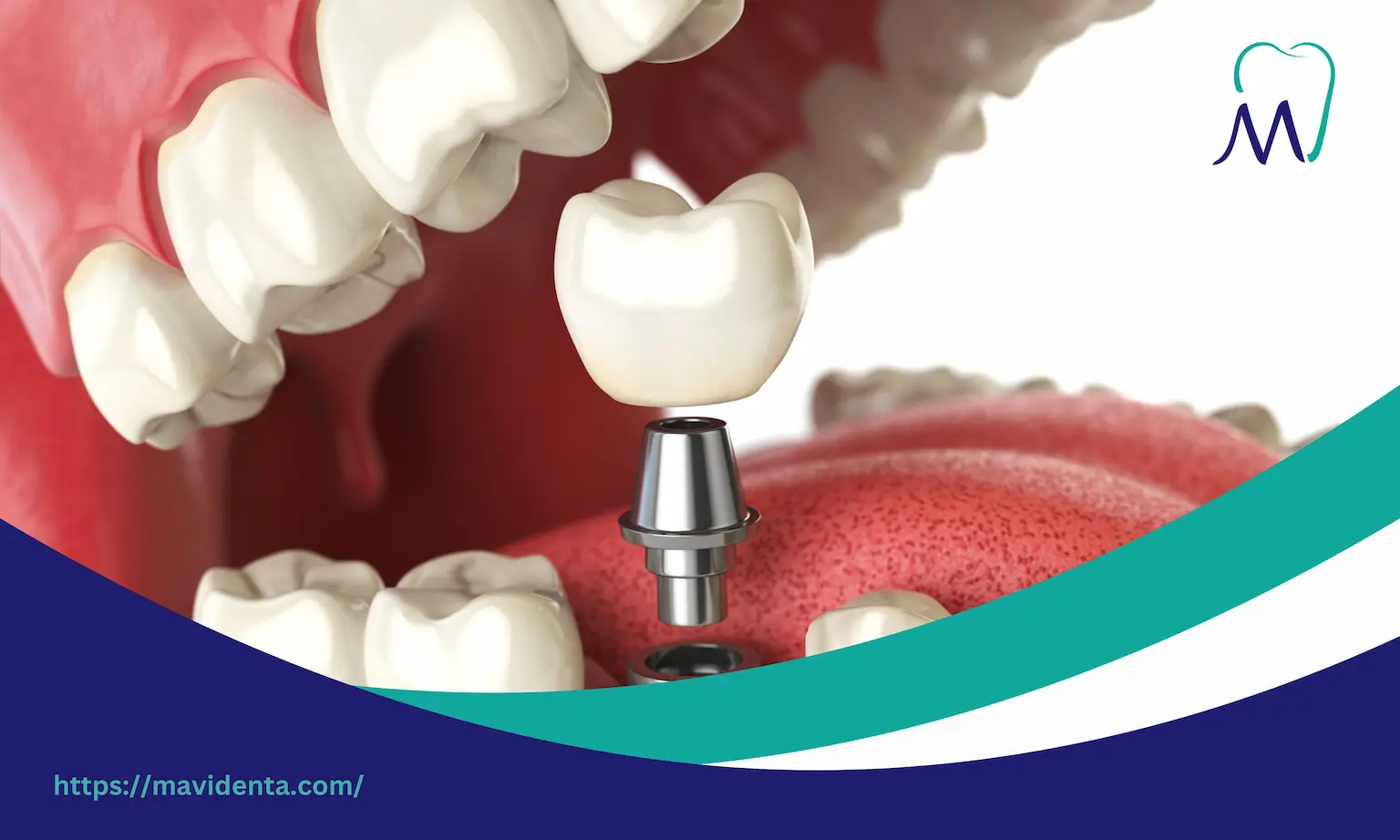 All on 4 Dental Implants Breaking Repair and Care Guide all on 4 dental implants vs snap in dentures