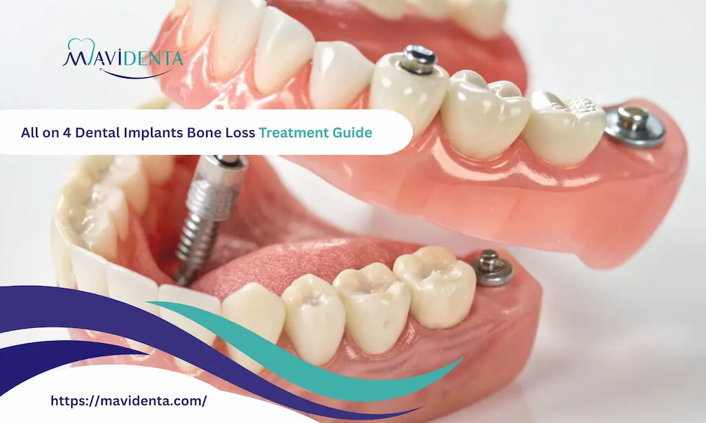 all on 4 dental implants bone loss