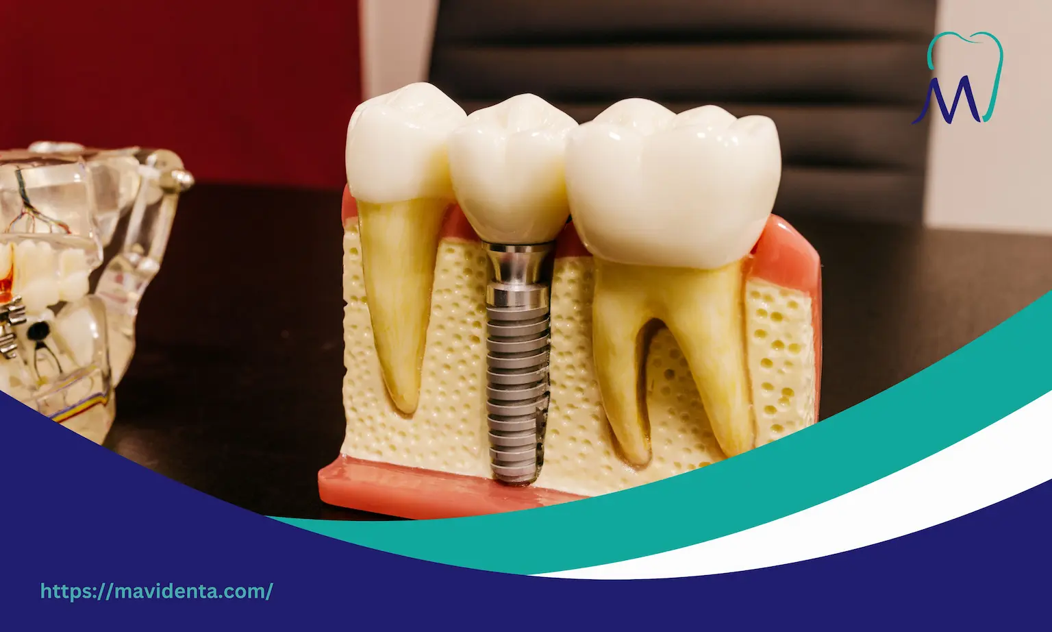 all on 4 dental implants bone loss