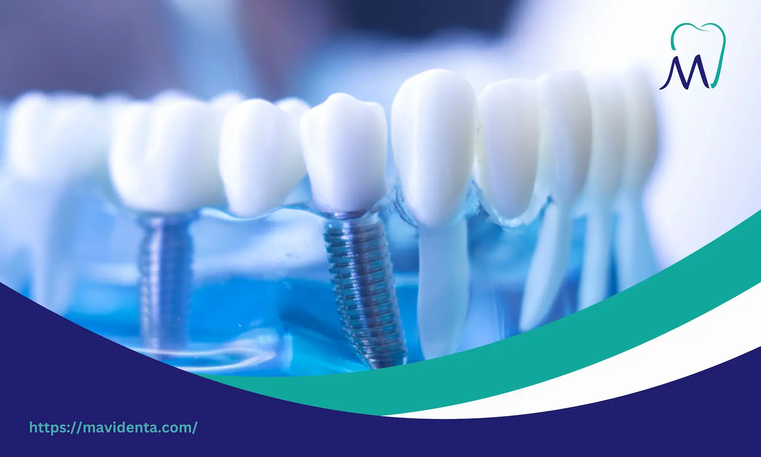 all on 6 dental implants problems​