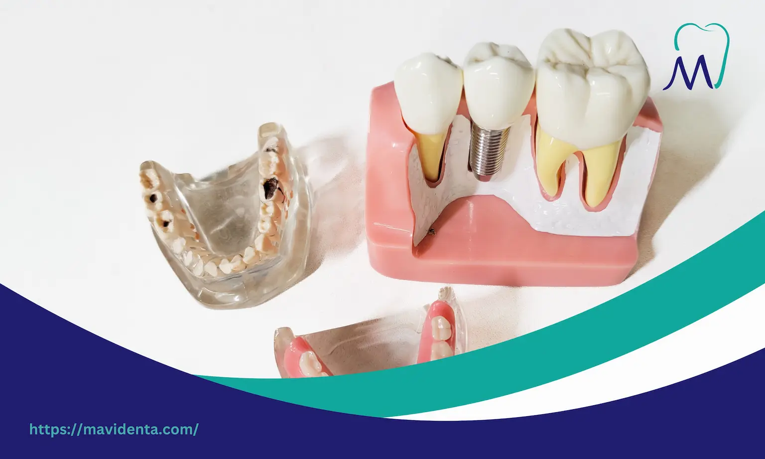 all on 6 dental implants recovery time all on 6 dental implants recovery time