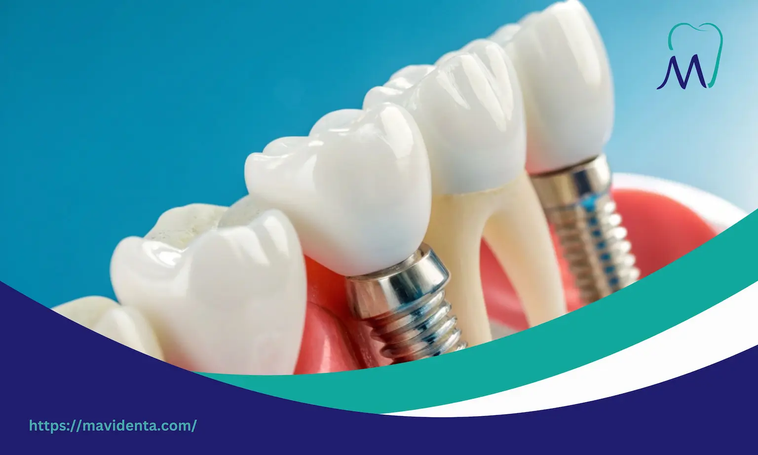 all on 6 temporary teeth  all on 6 temporary teeth