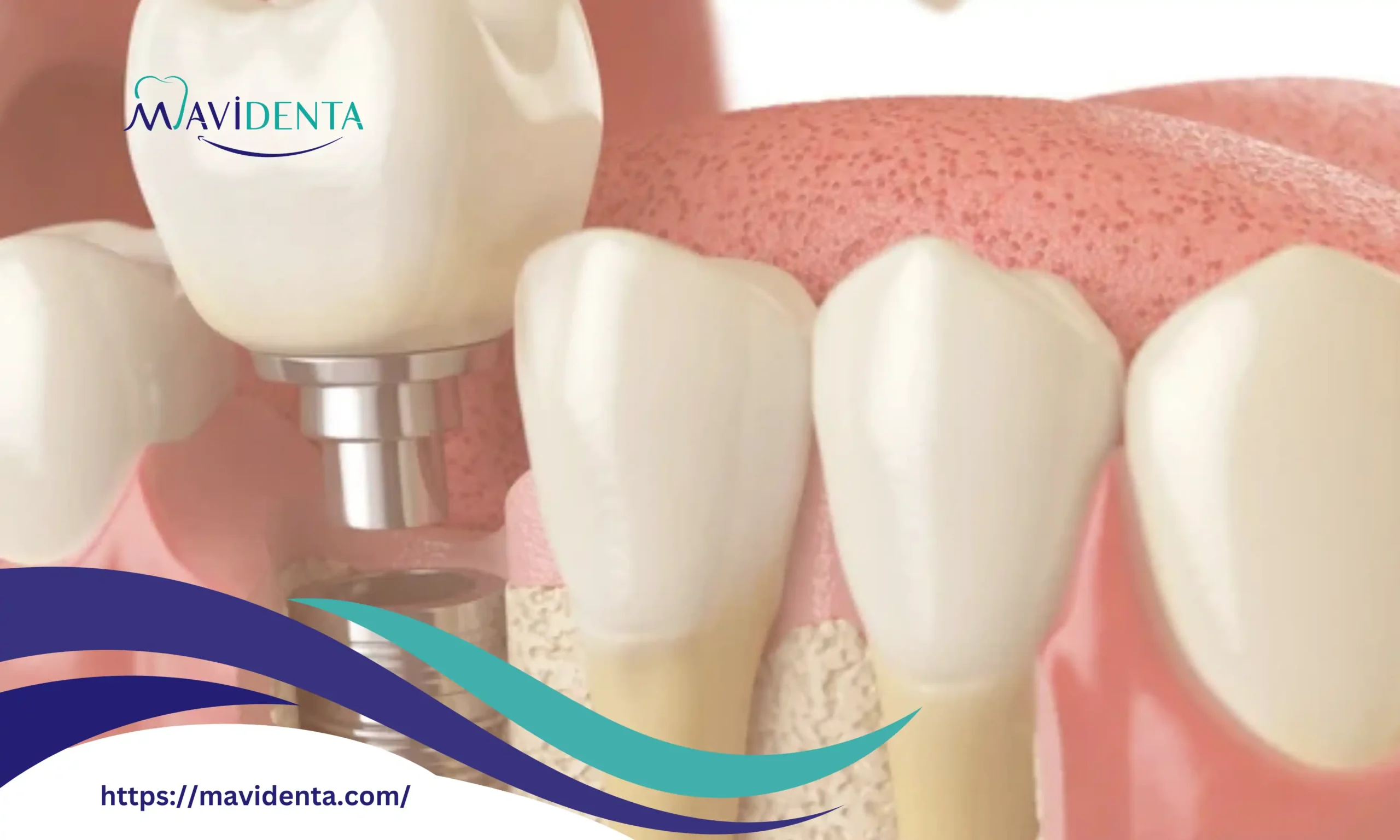 dental Bone Grafting