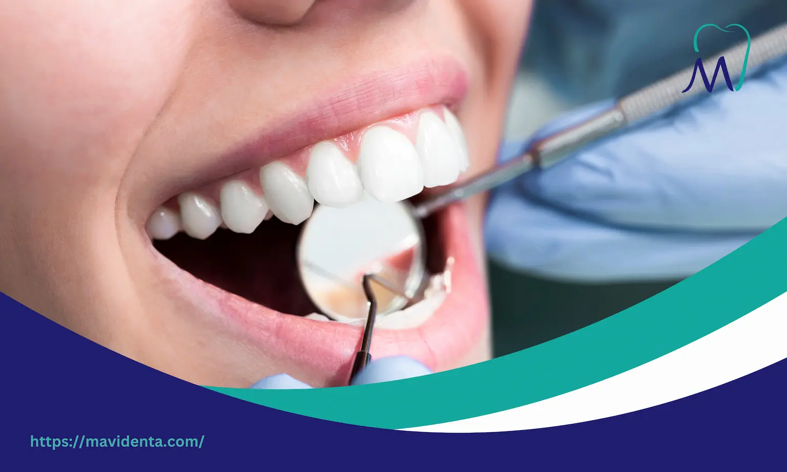 hollywood smile side effects​