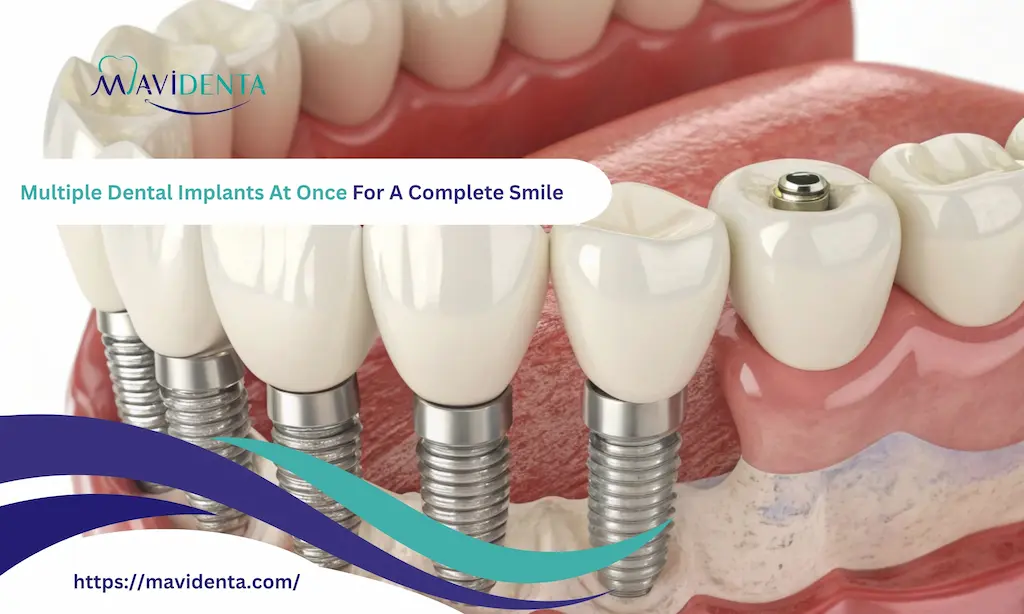 multiple dental implants at once