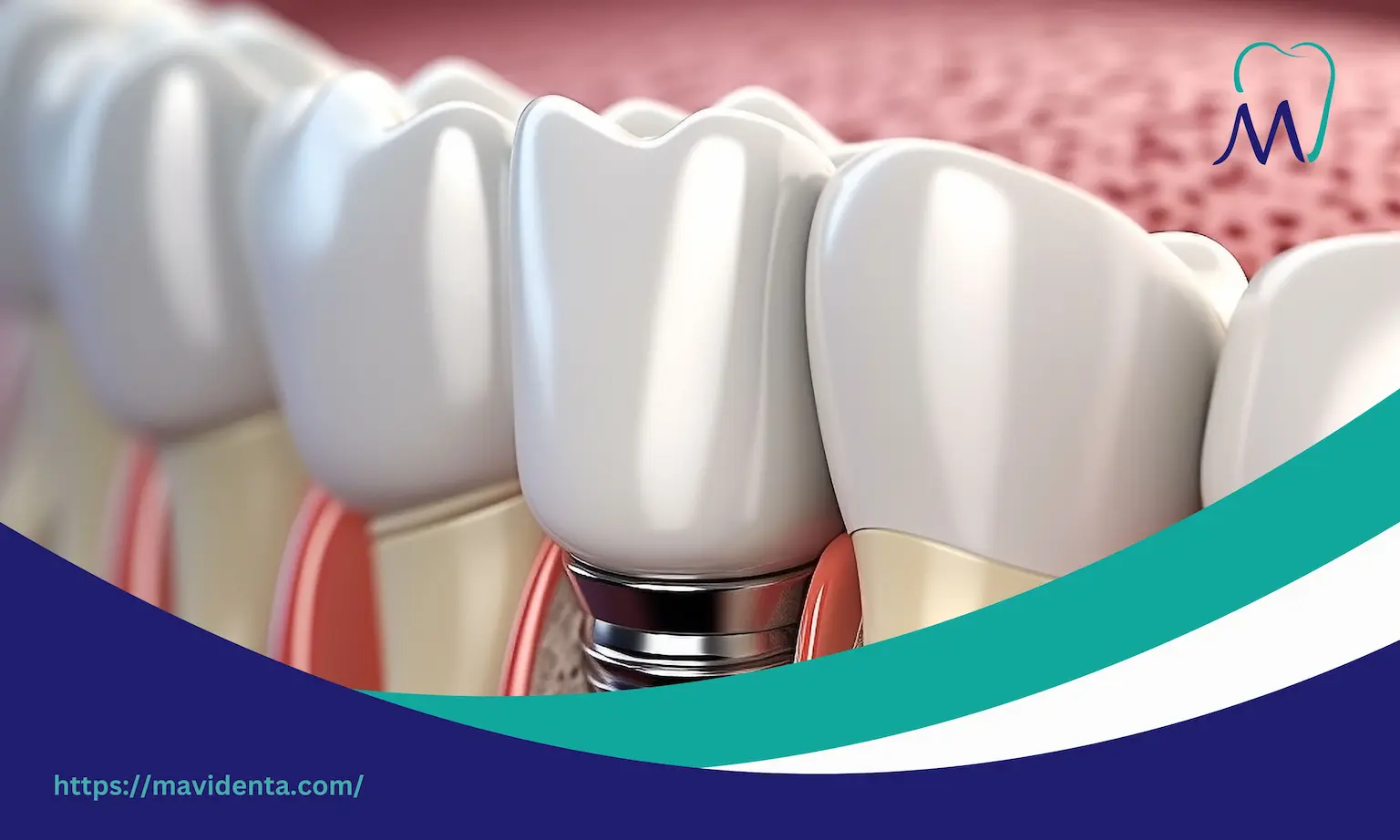 osteoporosis treatment and dental implants osteoporosis treatment and dental implants