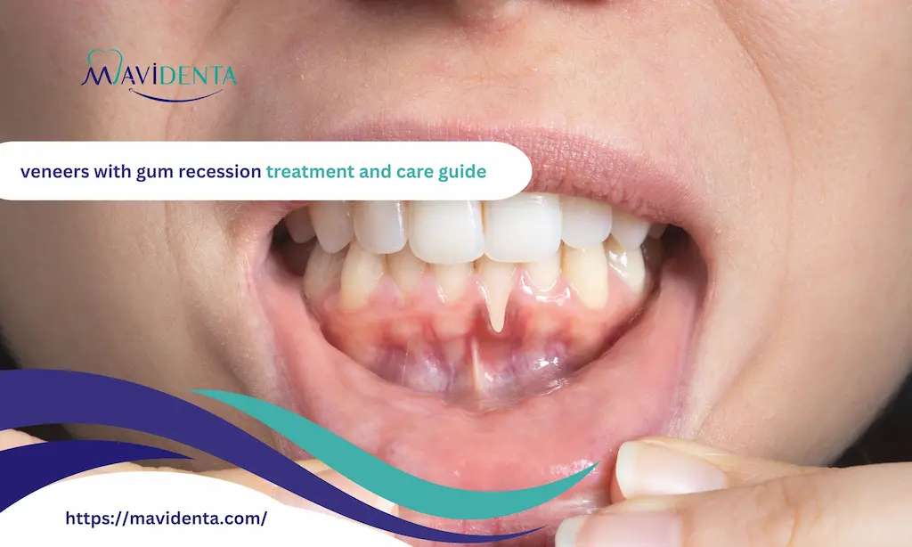 veneers with gum recession