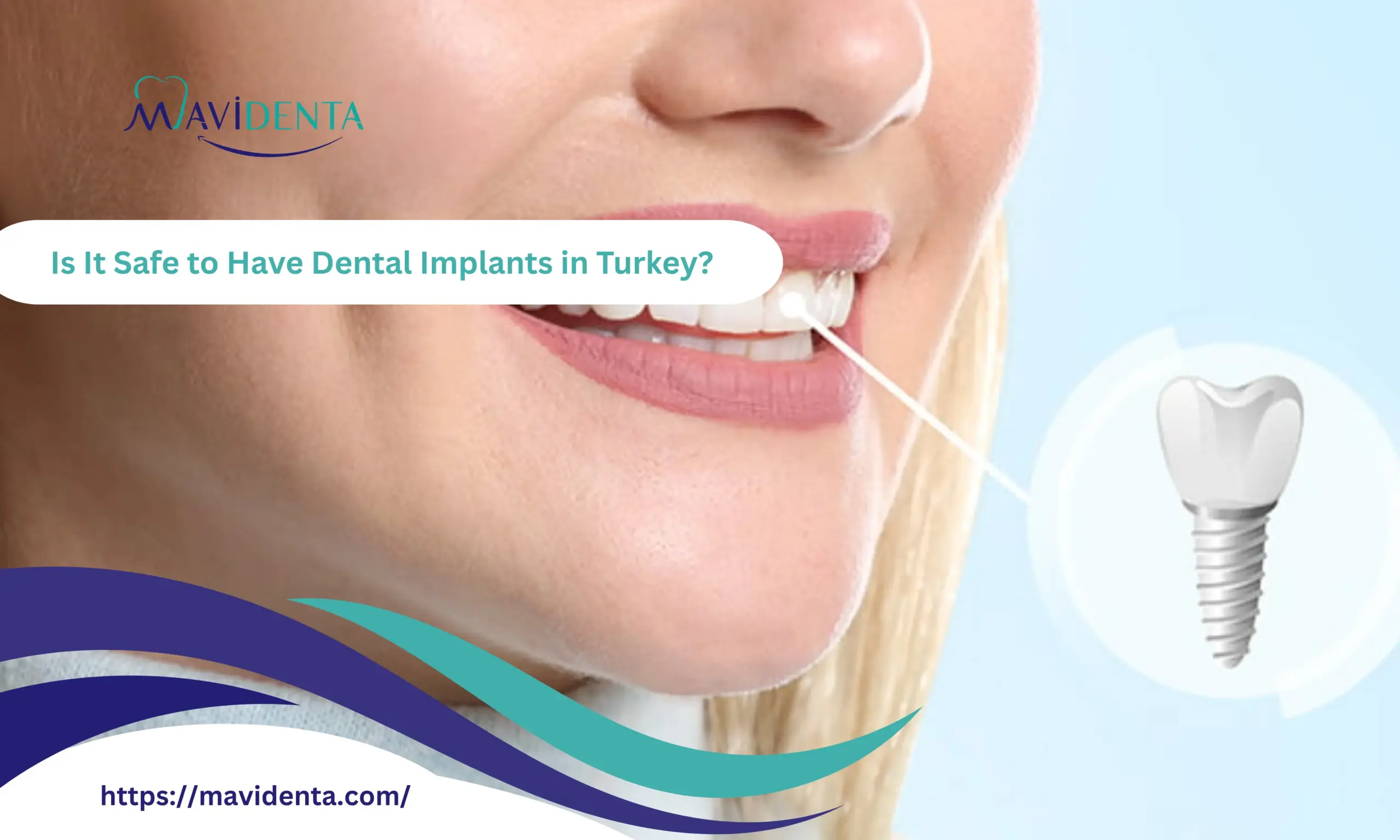 Is It Safe to Have Dental Implants in Turkey