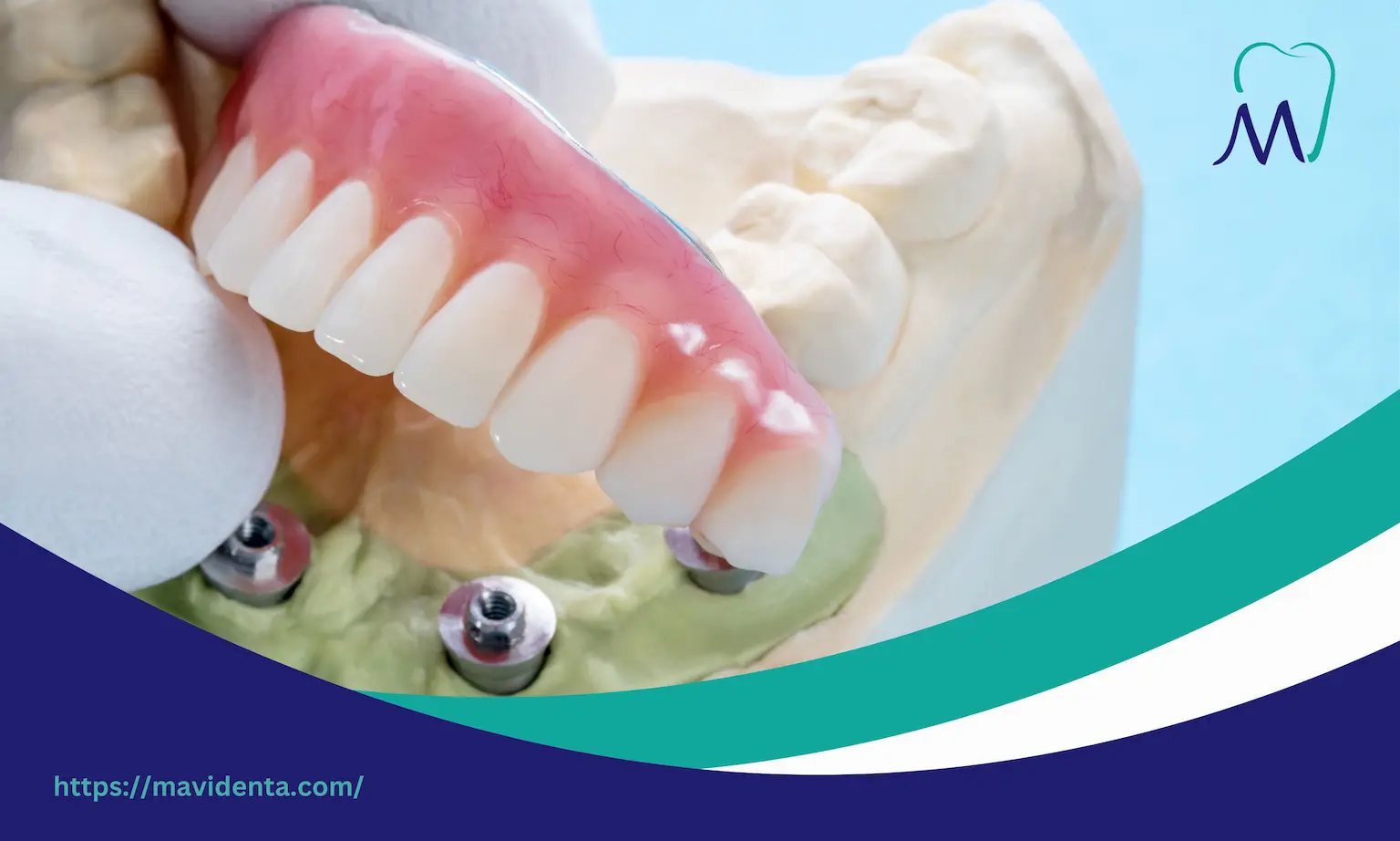non surgical dental implants cost