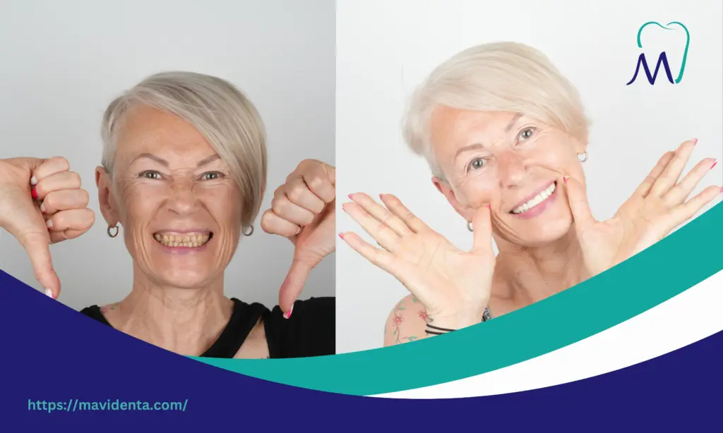 Best Place to Get Veneers in Turkey Complete Guide for UK Patients