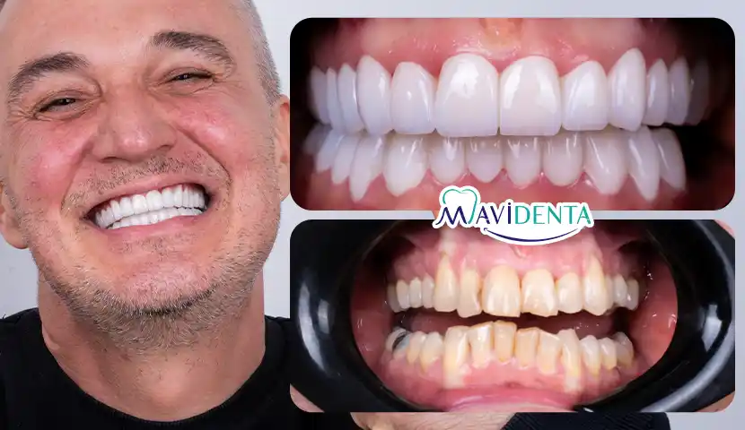 Veneers Turkey Package Premium Smile