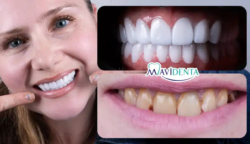 Veneers Turkey Package Premium Smile
