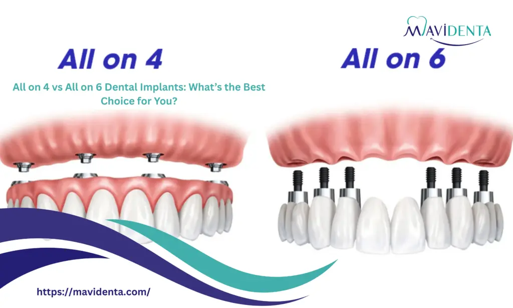 All on 4 vs All on 6 Dental Implants