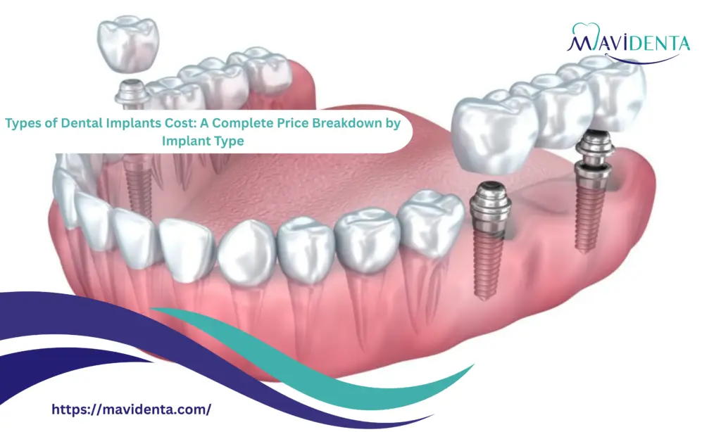 Types of Dental Implants Cost