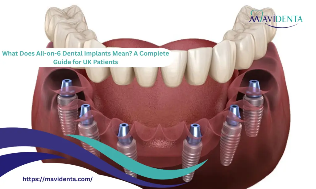 What Does All-on-6 Dental Implants Mean