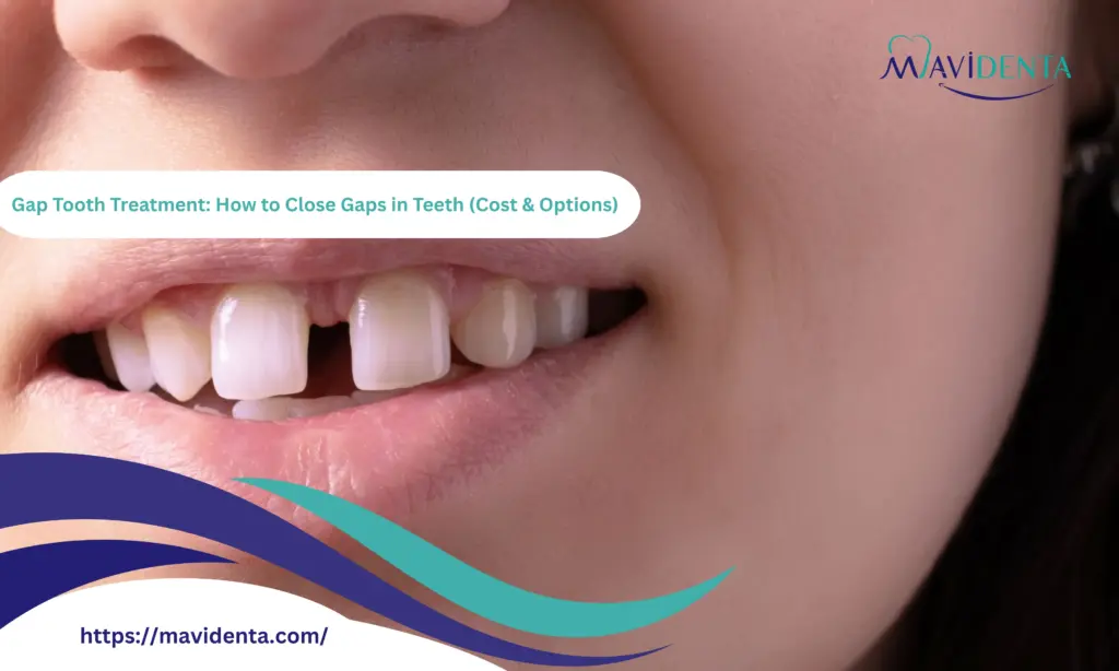 Gap Tooth Treatment