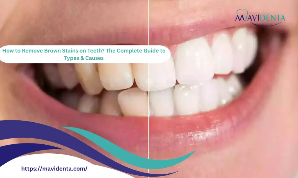 How to Remove Brown Stains on Teeth
