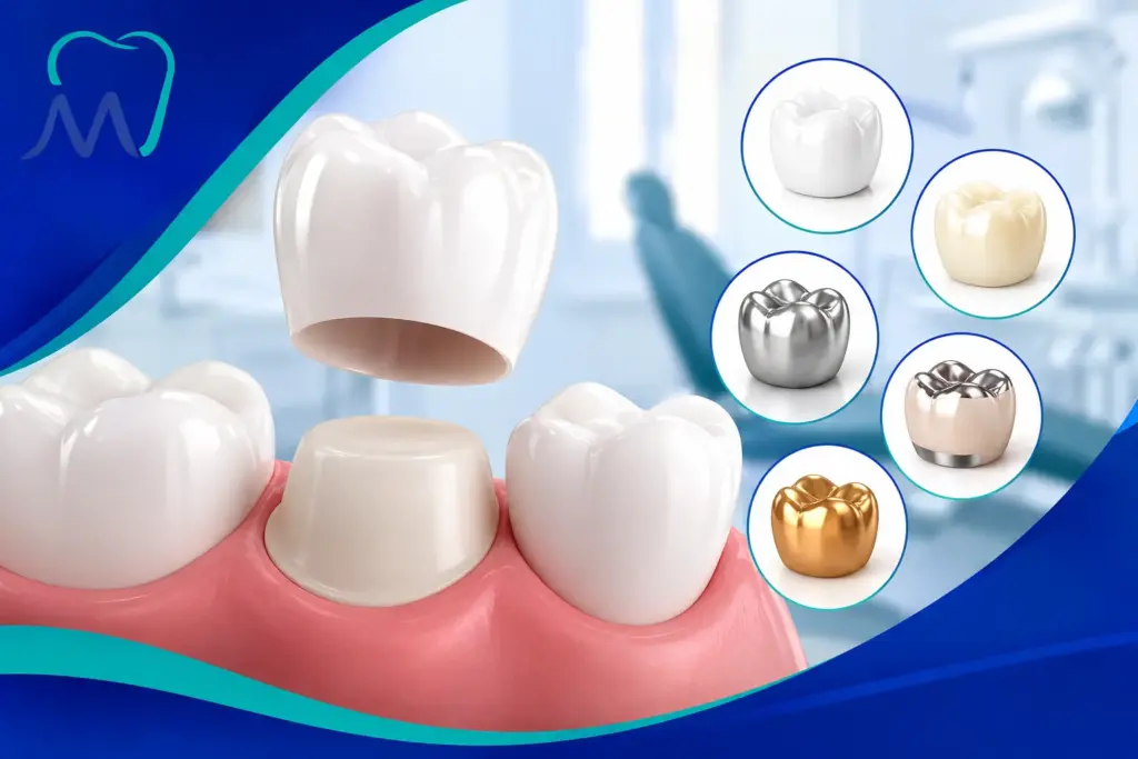 Types of Dental Crowns Explained