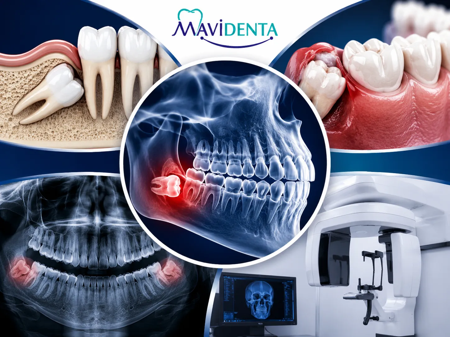 What is An Impacted Tooth