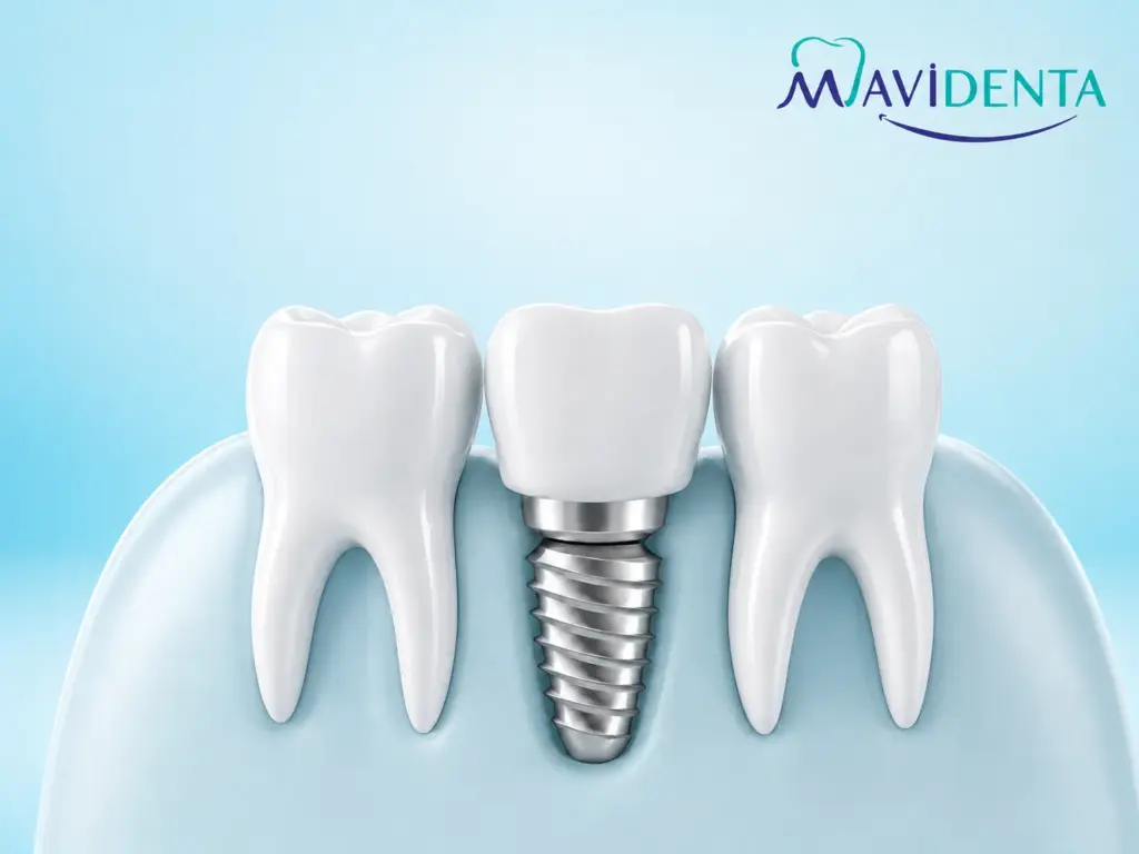 Best Dental Implant Brands