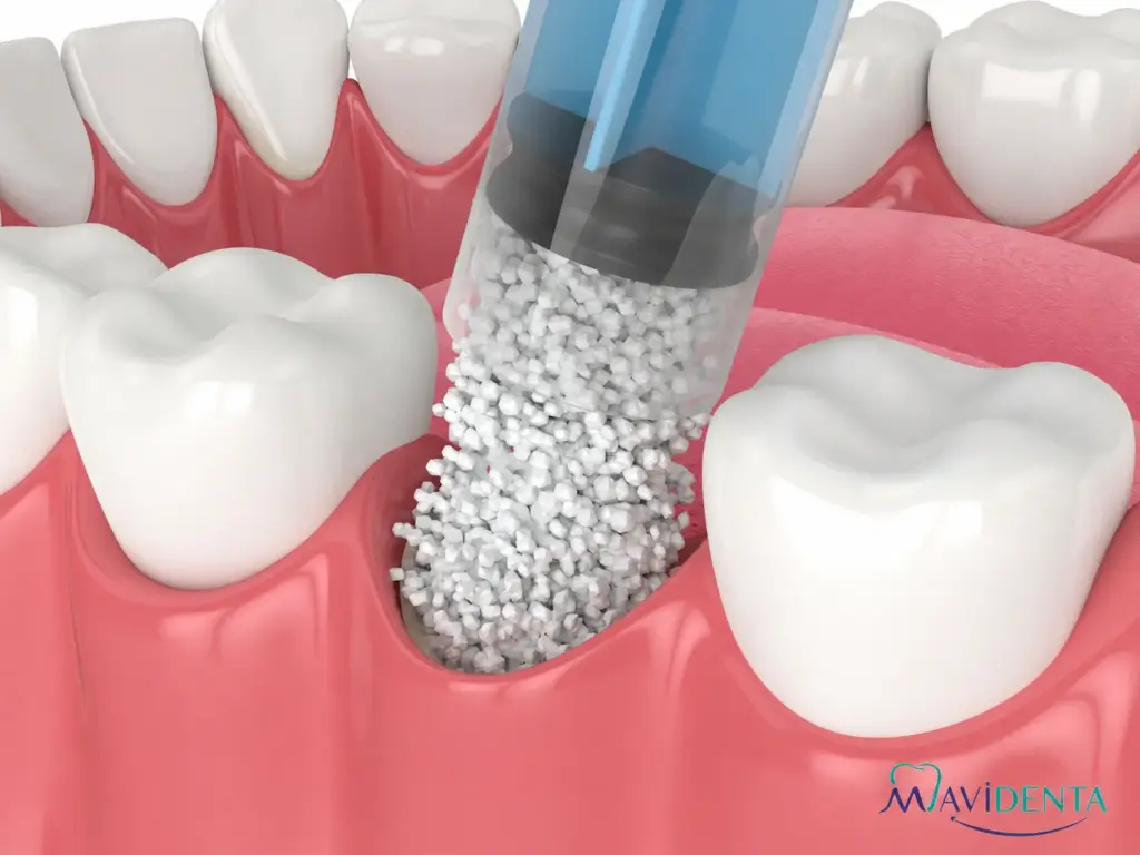 Es doloroso el injerto de hueso dental