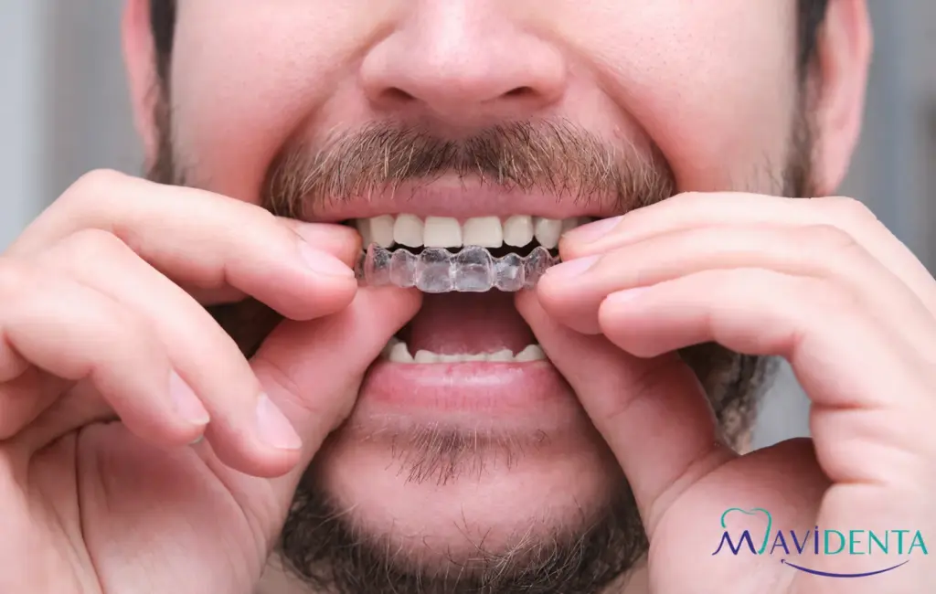 Ortodoncia invisible con implantes