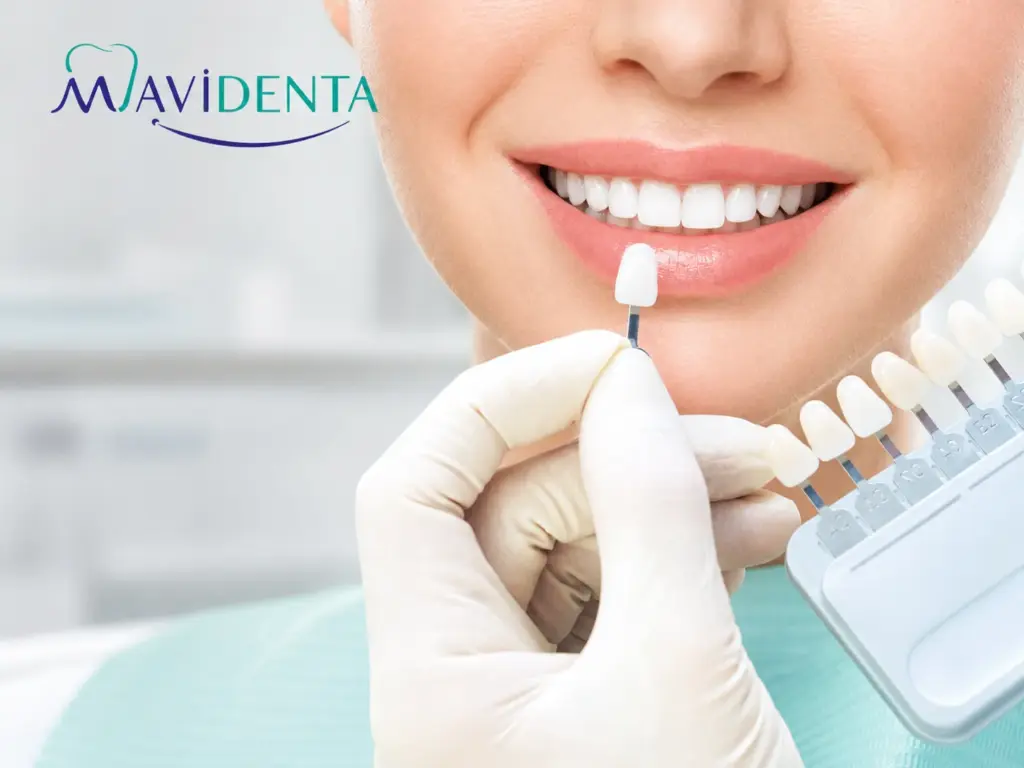 Requisitos para ponerse carillas dentales