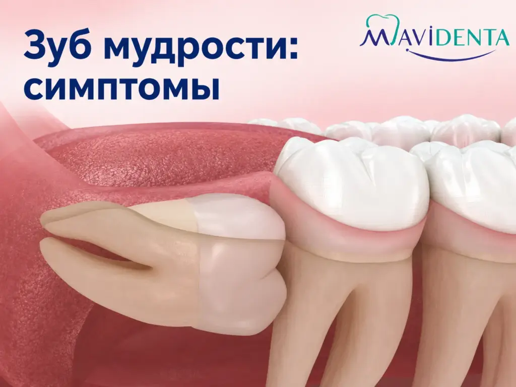 Зуб мудрости симптомы
