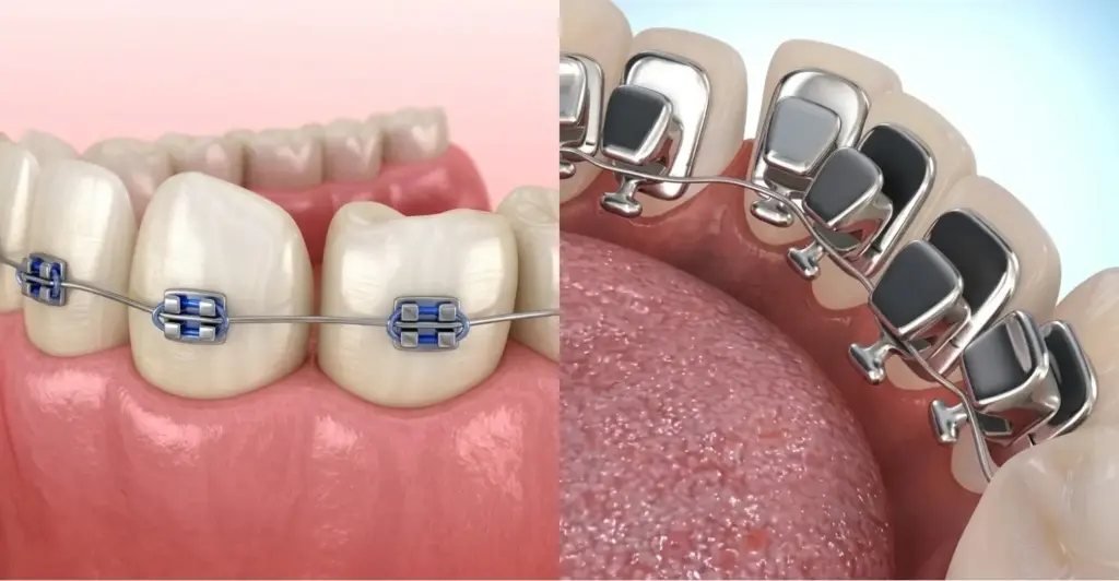 Braces vs Lingual Braces