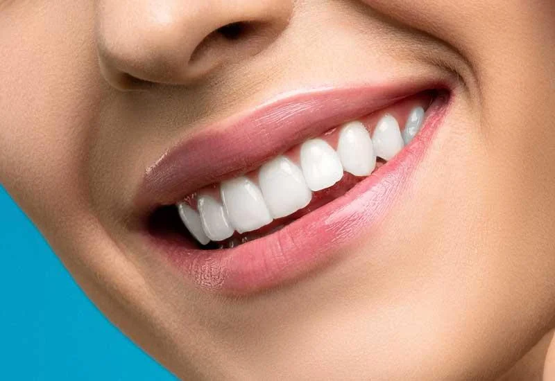 Diseño de sonrisa digital