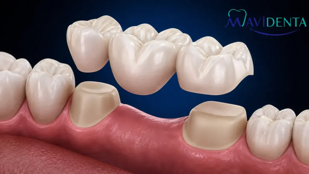 Implantes dentales sin tornillos