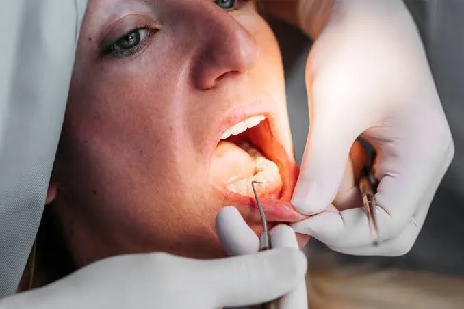 Qué es un curetaje dental