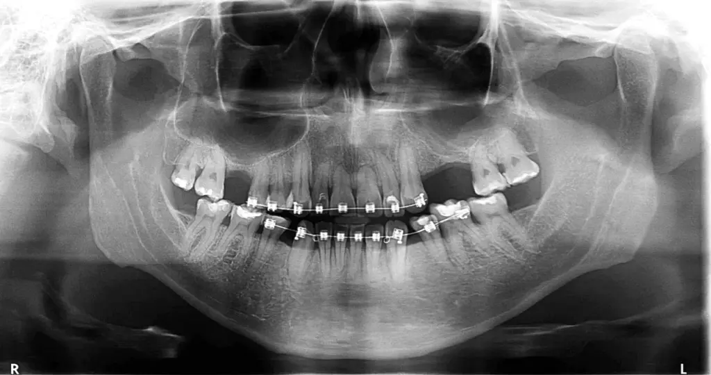Reabsorción dental