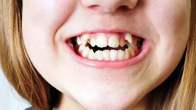 Extracción de dientes supernumerarios